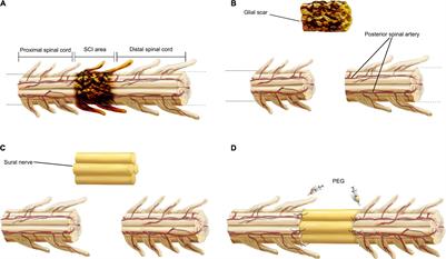 Partial Restoration of Spinal Cord Neural Continuity via Sural Nerve Transplantation Using a Technique of Spinal Cord Fusion